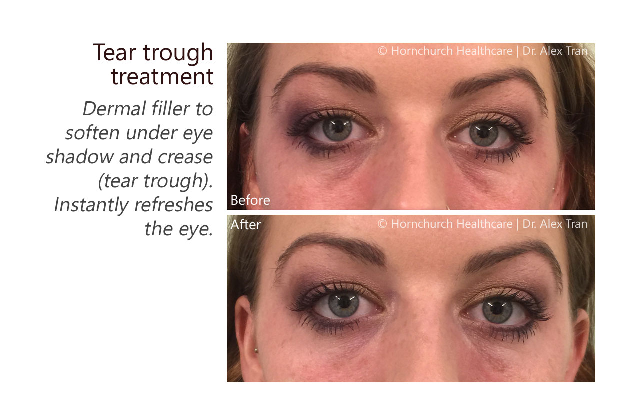 Tear trough treatment
