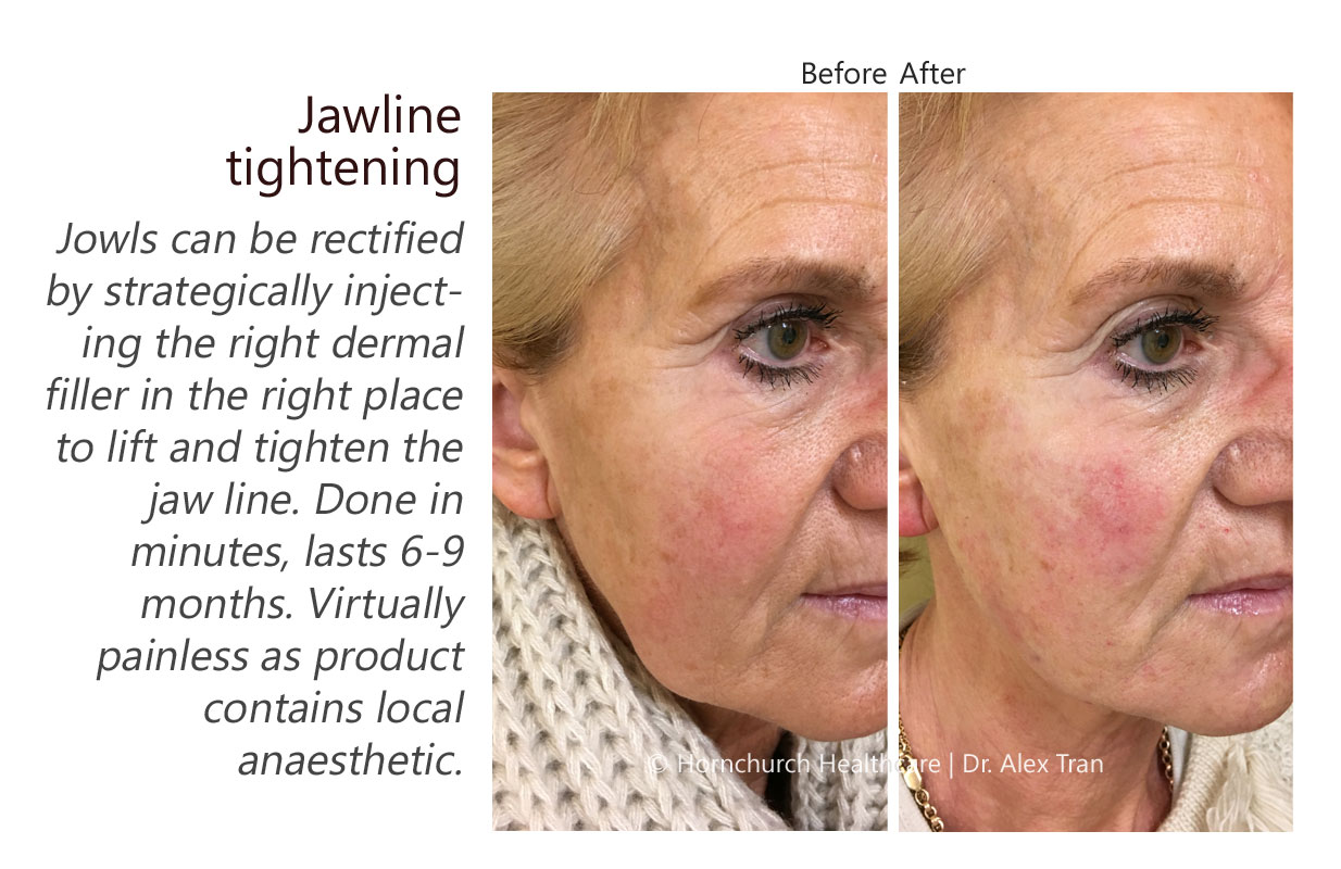 Jawline tightening treatment