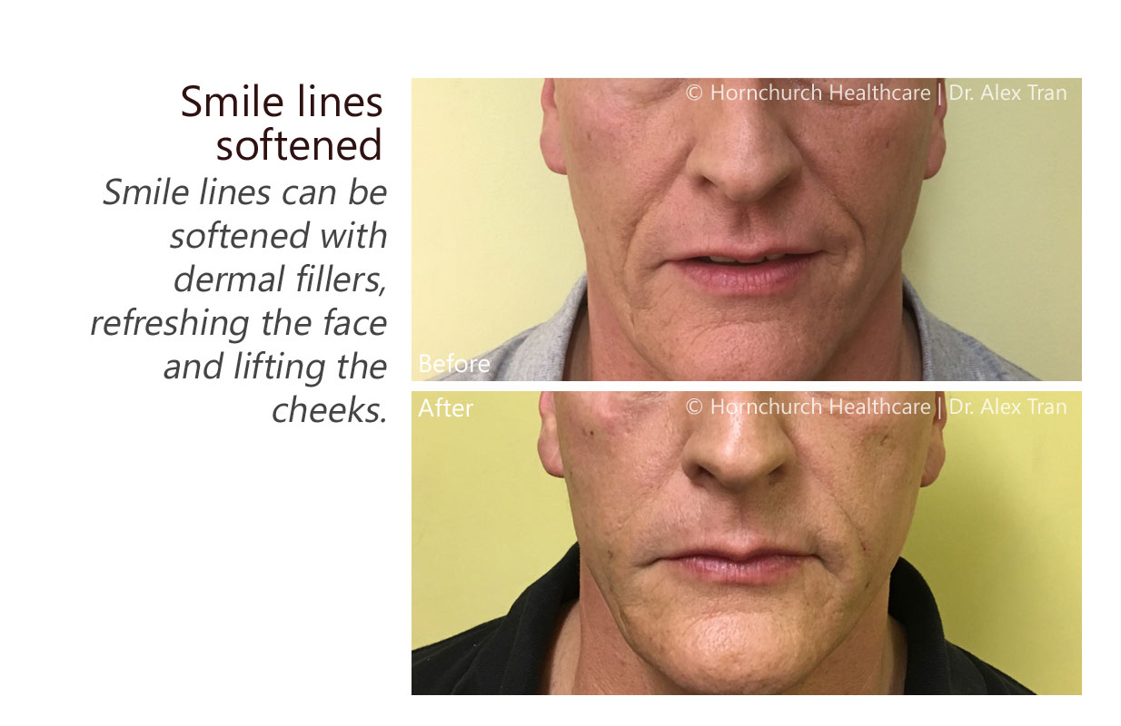 Smile lines softened treatment