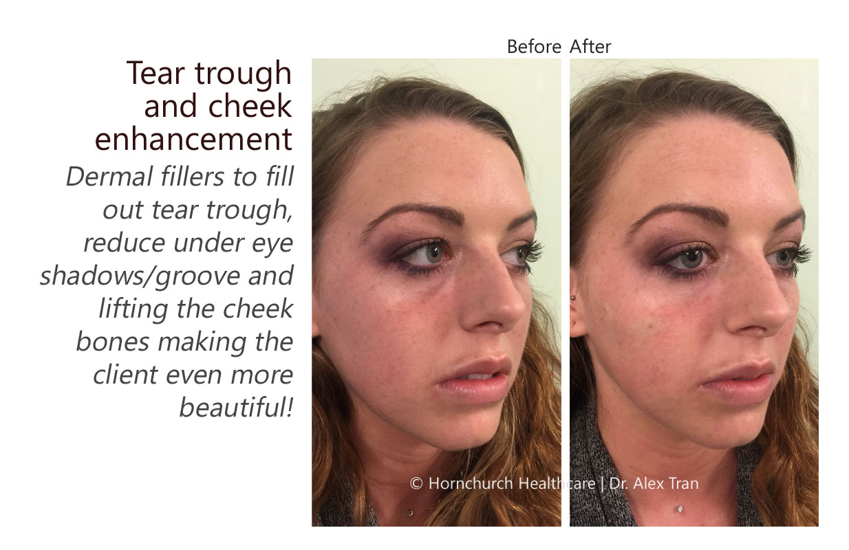 Tear trough and cheek enhancement treatment