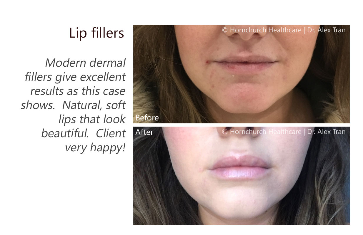 Lip fillers treatment