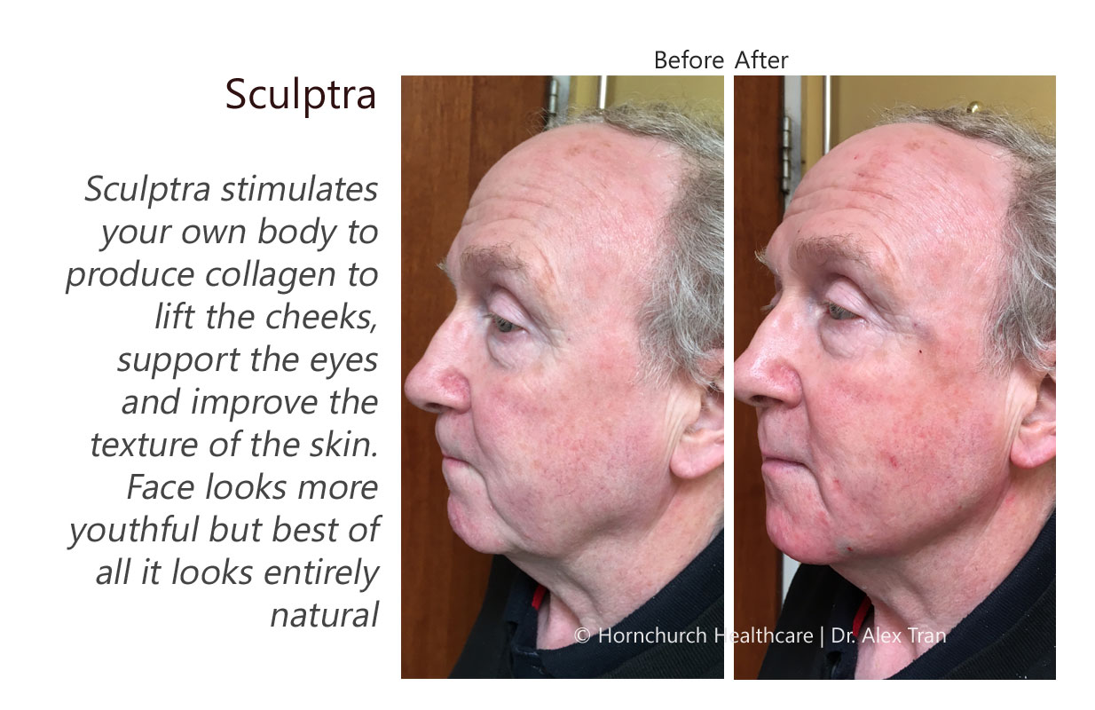 Sculptra treatment
