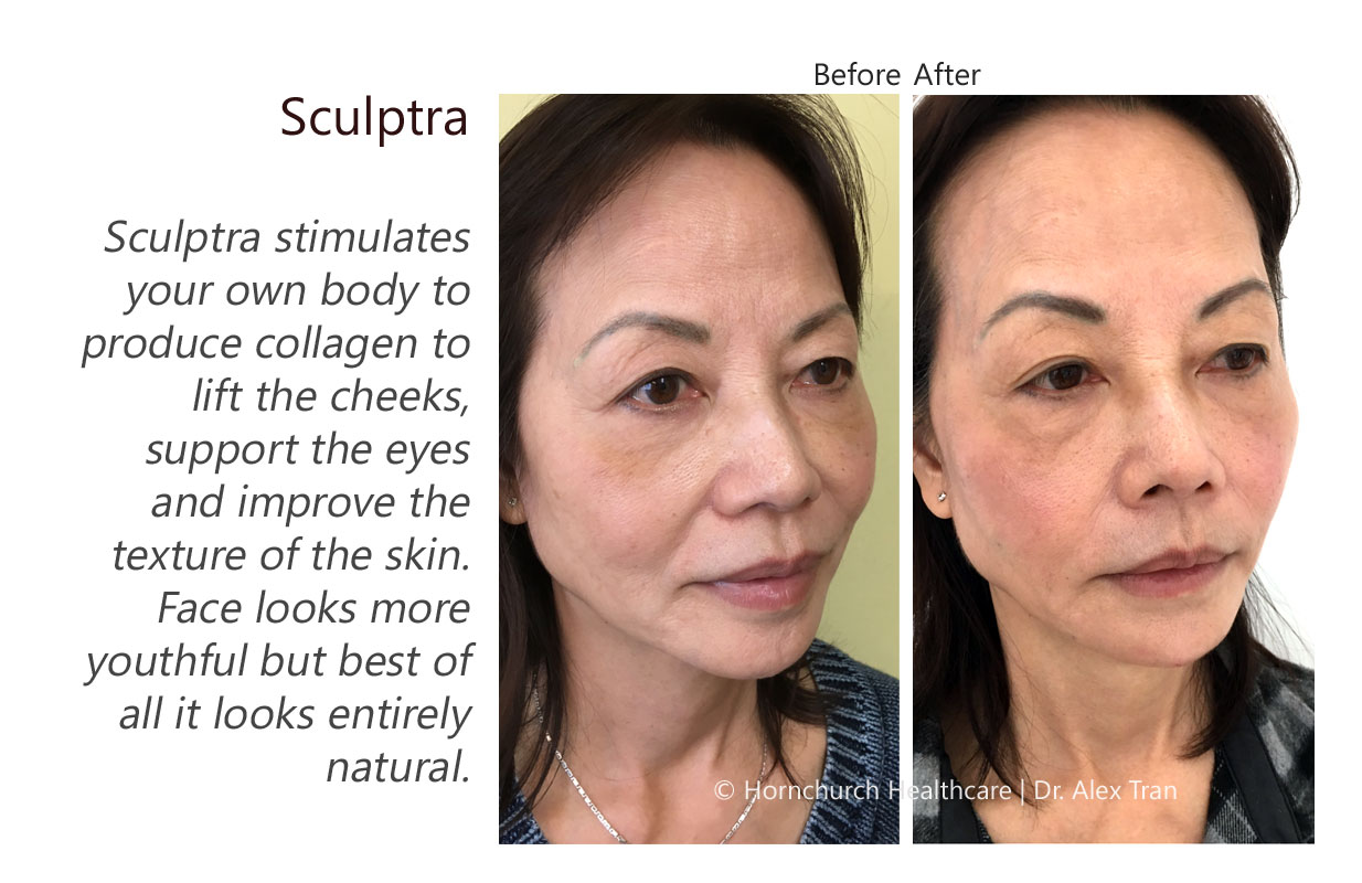 Sculptra treatment