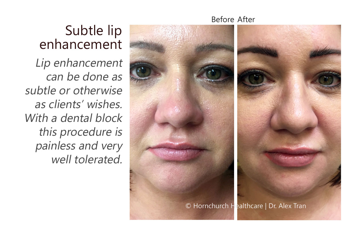 Subtle lip enhancement treatment