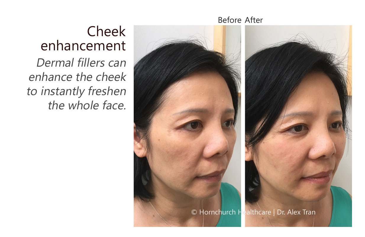 Cheek enhancement treatment