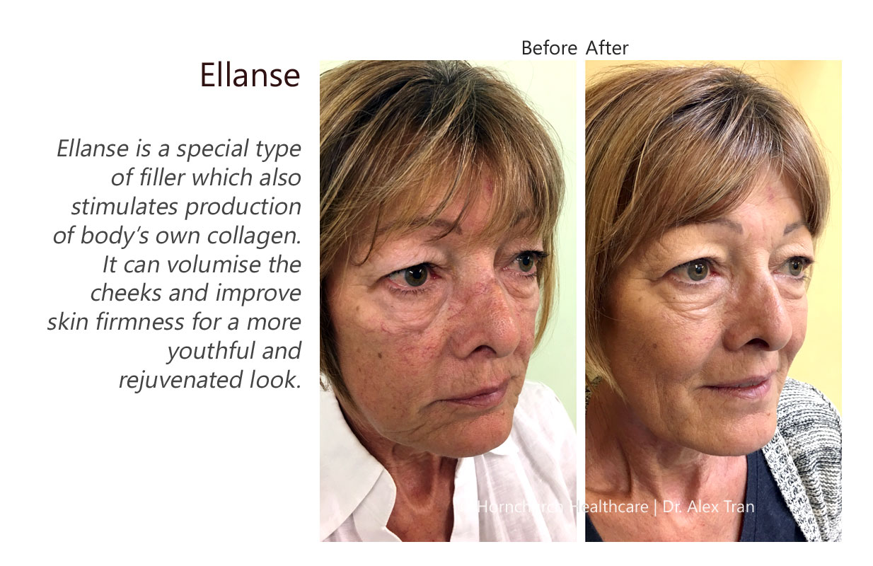 Ellansé treatment
