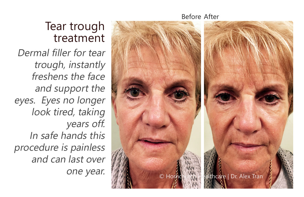 Tear trough treatment