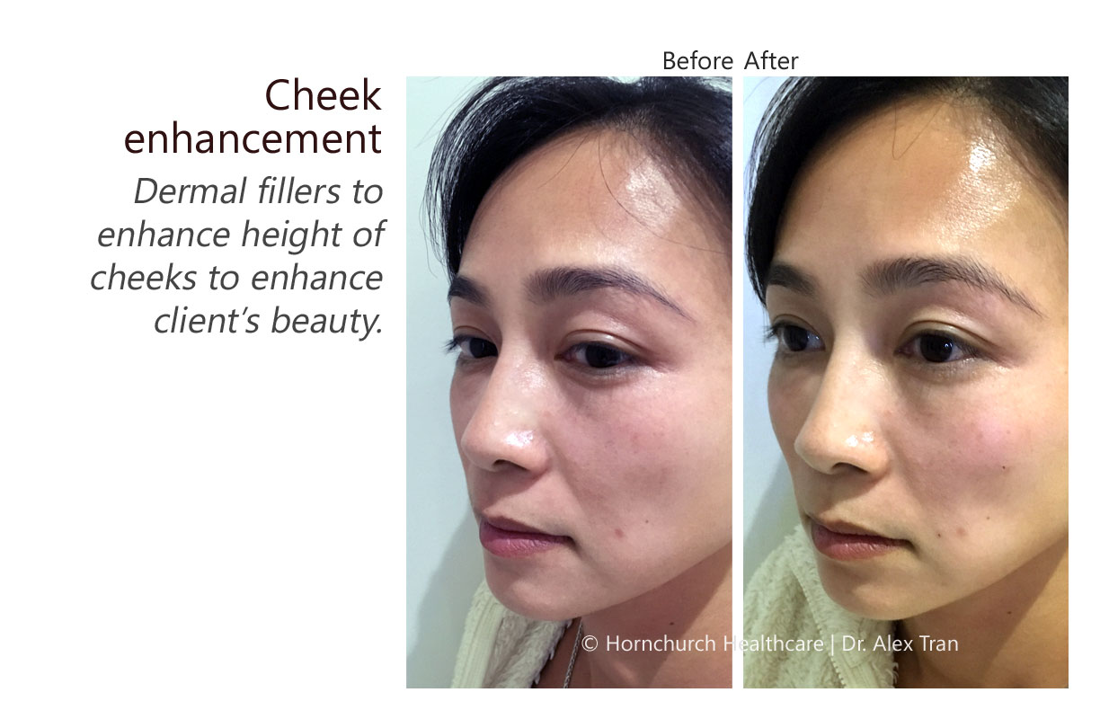 Cheek enhancement treatment