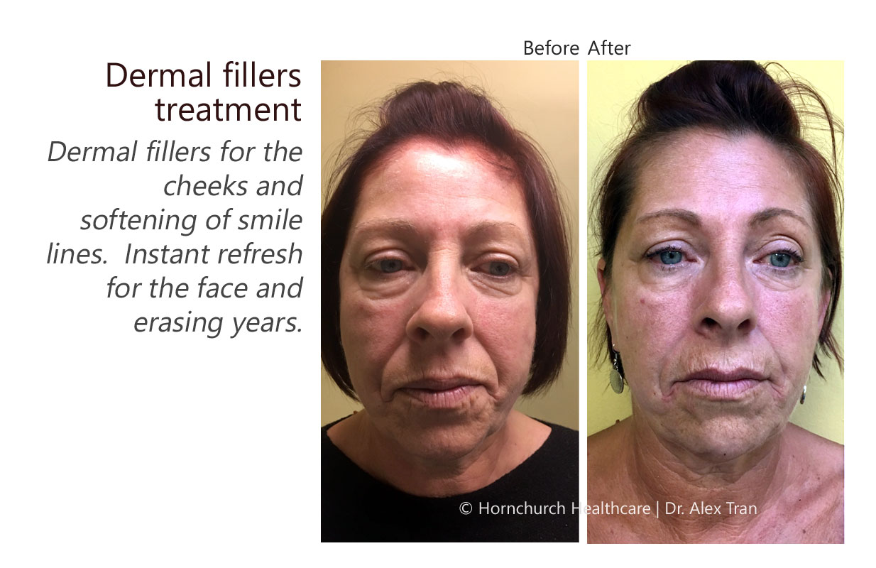 Dermal fillers treatment