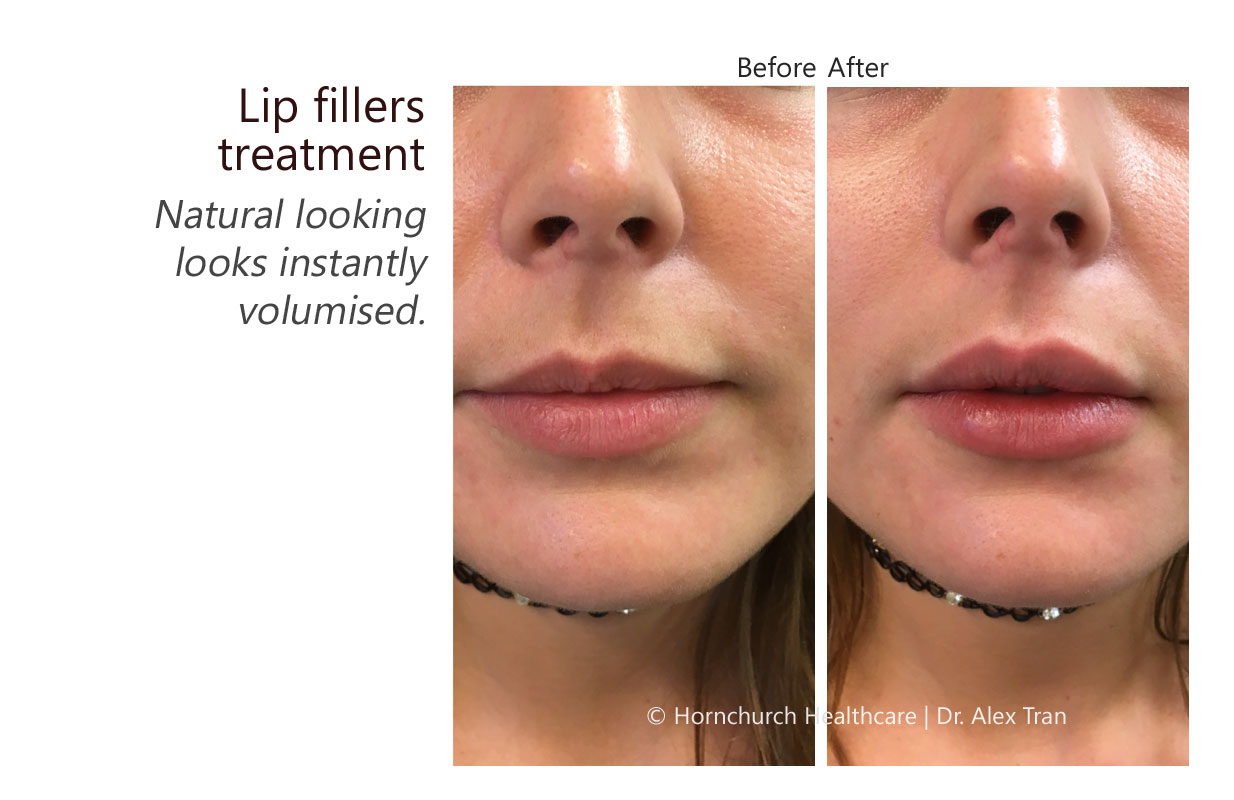 Lip fillers treatment