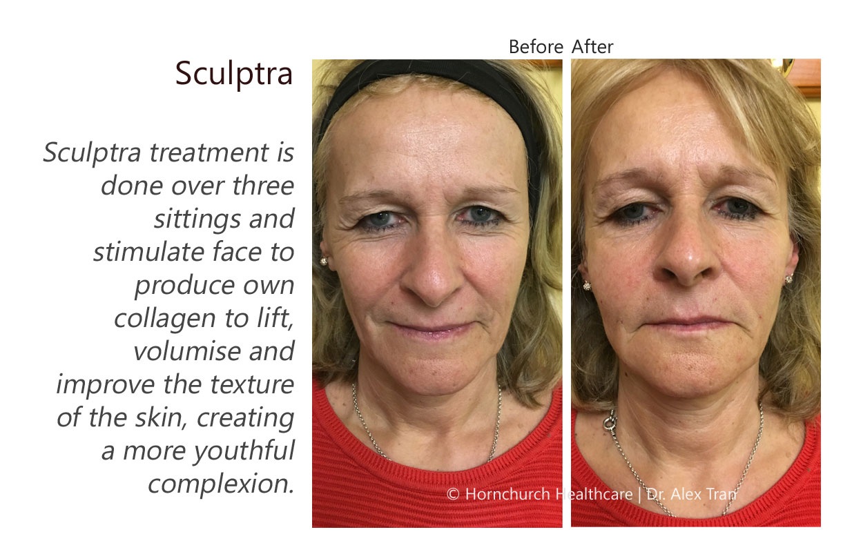 Sculptra treatment