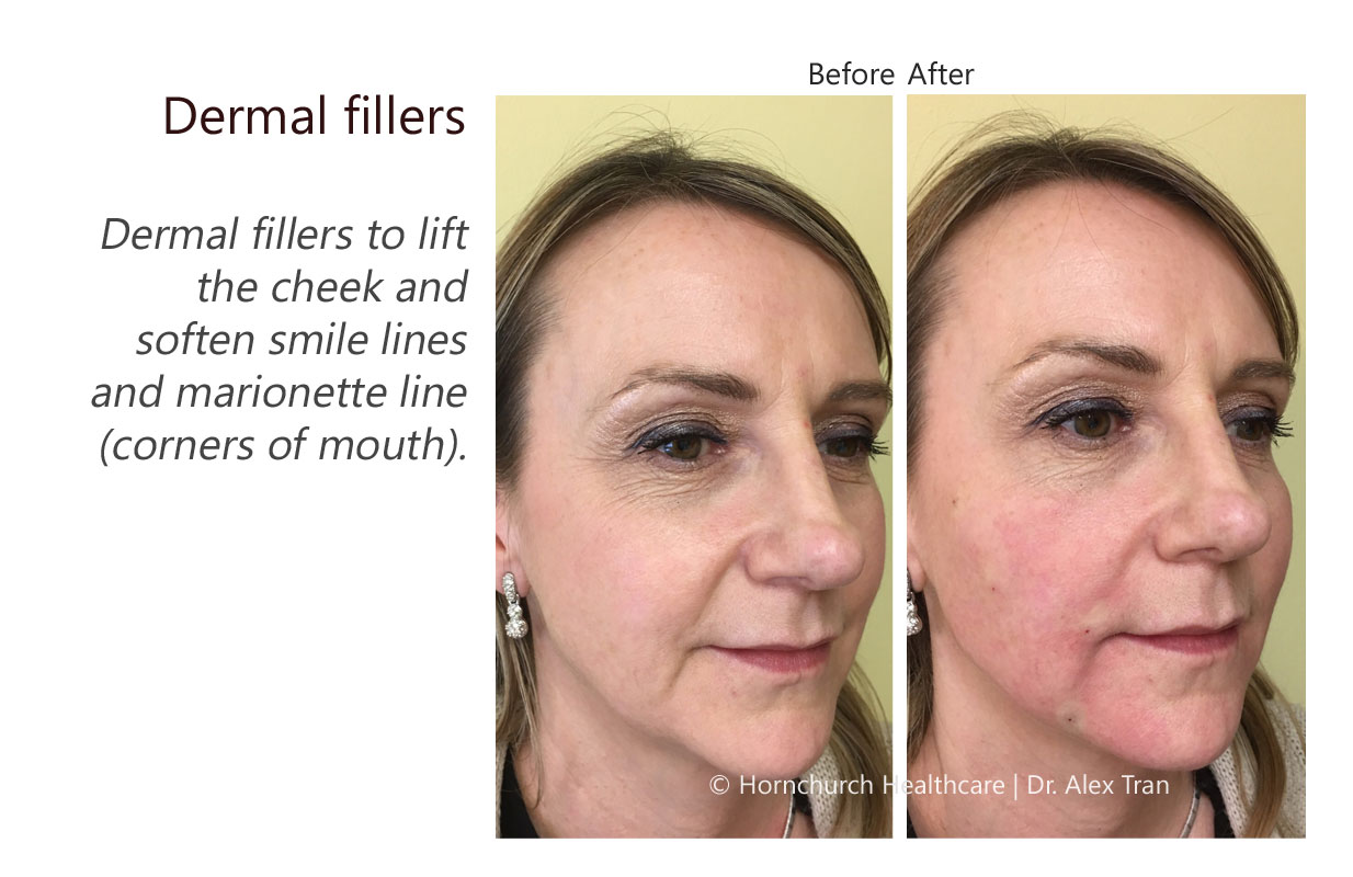 Dermal fillers treatment