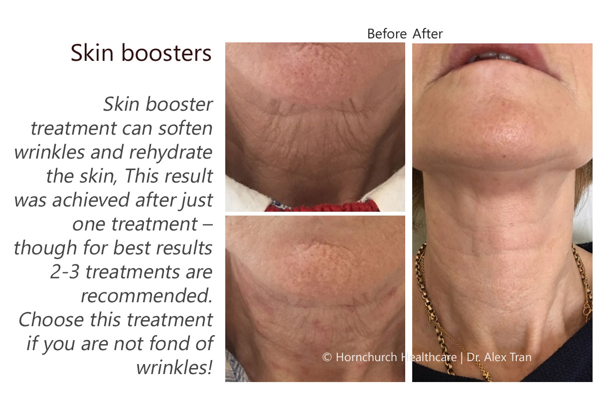 Skin booster treatment