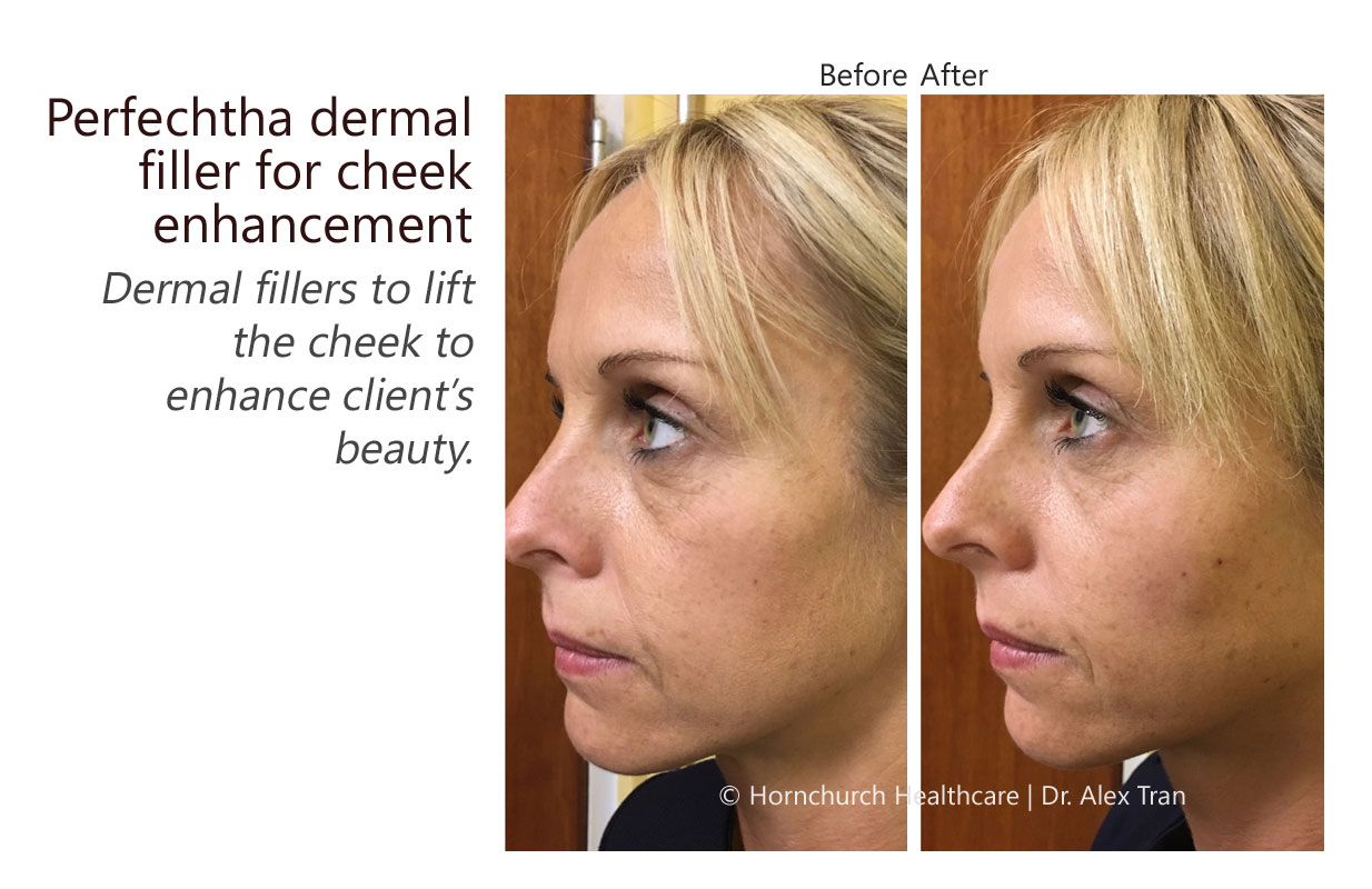 Perfechtha dermal filler for cheek enhancement treatment