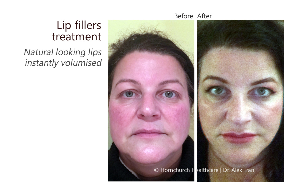 Lip fillers treatment