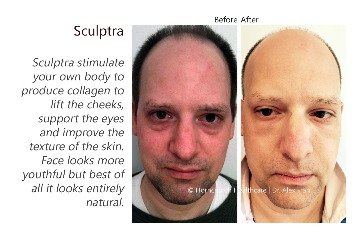 Sculptra treatment