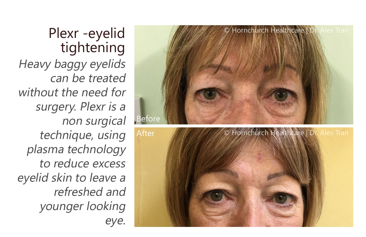 Plexr - eyelid tightening treatment