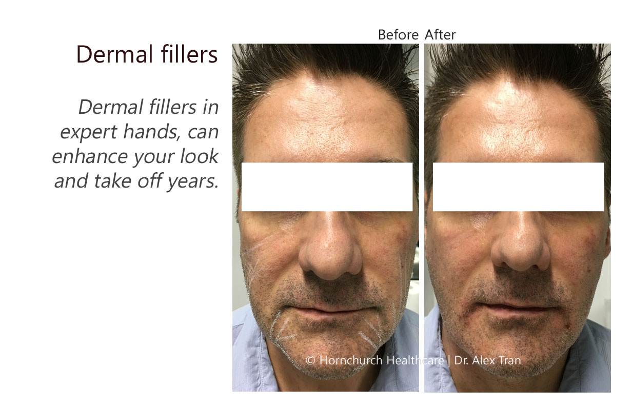 Dermal fillers treatment