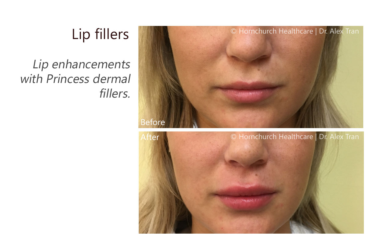 Lip fillers treatment